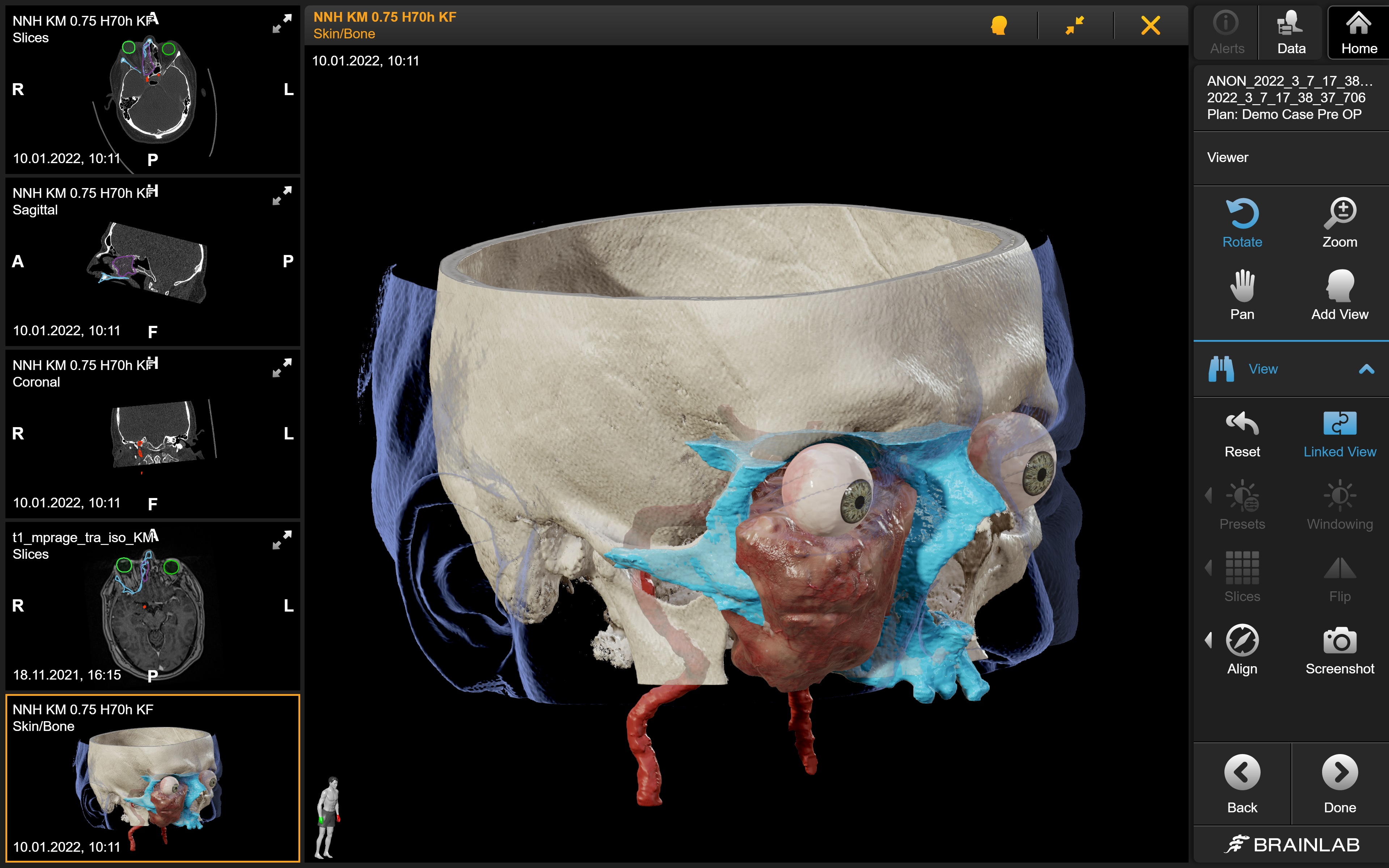 Mit diesen 3D-Strukturen können anatomische Strukturen genau betrachtet und damit einerseits zielgerichtete Operationen ermöglicht, andererseits auch Studierende ideal unterrichtet werden / Foto © Brainlab/Universitätsklinikum Düsseldorf